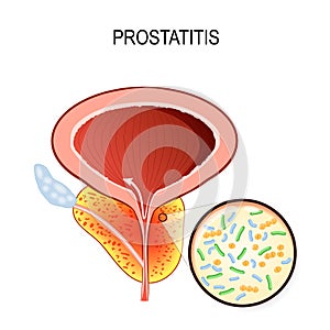 Prostatitis. Close-up of Bacteria that cause inflammation: Escherichia coli, Pseudomonas aeruginosa and Enterococcus photo