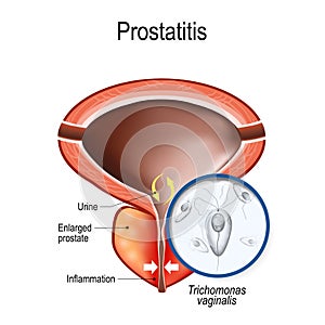 Prostatitis and close-up of Trichomonas vaginalis photo