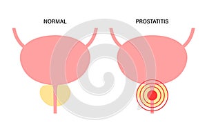 Prostatitis inflammation problem