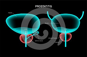 Prostatitis inflammation problem