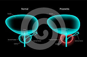 Prostatitis inflammation problem