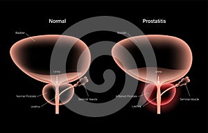 Prostatitis inflammation problem photo