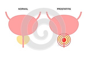 Prostatitis inflammation problem photo