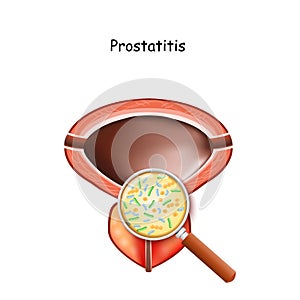 Prostatitis. Male bladder and prostate photo