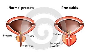 Prostatitis photo