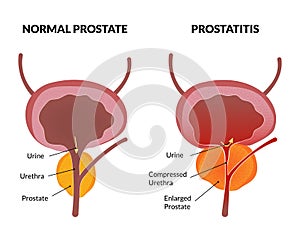 Prostatitis pathology poster photo