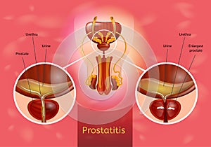 Prostatitis Realistic Vector Medical Scheme