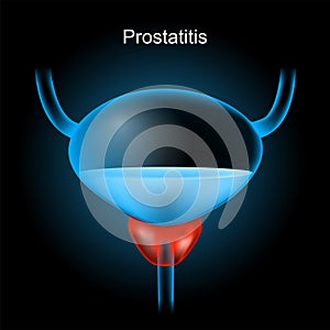 Prostatitis. Red Prostate gland and blue realistic bladder photo