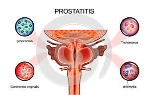 Prostatitis. sexual infections photo