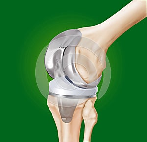 Prosthesis of the knee surgical