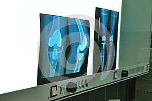 Prosthesis of the knee xray