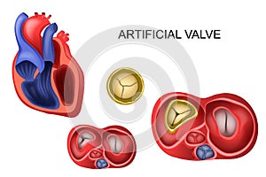 Prosthetic tricuspid heart valve