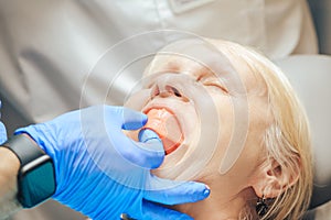 Prosthetics of the removable jaw of an elderly woman