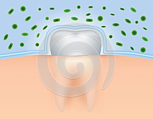 Protect Teeth from Bacteria