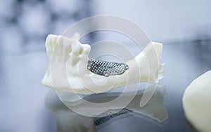 Prototype lower human jaw medical titanium implant from biocompatible titanium photo