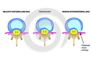 Protrusion of the intervertebral disc. Hernia. Vector illustration on isolated background.