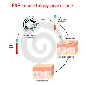 PRP cosmetology procedure. test tubes and syringe with blood and platelet-rich plasma