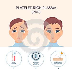 PRP hair loss treatment procedure medical poster