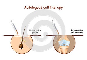 Prp. Platelet-rich plasma. Autologous cell therapy photo