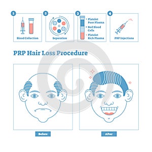 PRP Procedure, men`s beauty and health cosmetology scheme. Male baldness issues and solution.