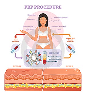 PRP Procedure vector illustration graphic diagram, cosmetology procedure scheme.