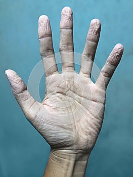 Pruney hand due to long soaking in the water. Handâ€™s skin shrinking