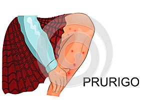 Pruritus, itching and skin lesions in a child