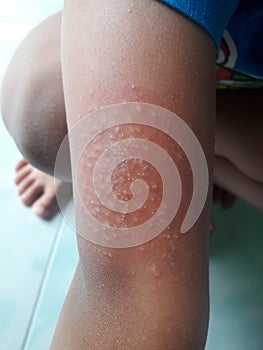 Pruritus, skin rash in children, allergy