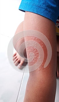 Pruritus, skin rash in children, allergy