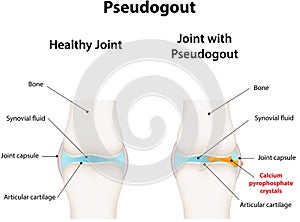 Pseudogout