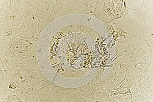 Pseudohyphae and budding yeast cells in patient urine