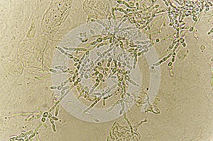 Pseudohyphae and budding yeast cells in patient urine