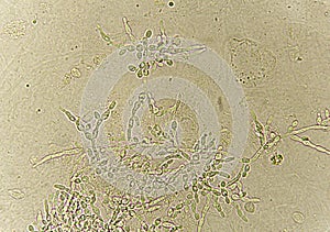 Pseudohyphae and budding yeast cells in patient urine