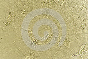 Pseudohyphae and budding yeast cells in patient urine