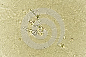 Pseudohyphae and budding yeast cells in patient urine