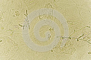 Pseudohyphae and budding yeast cells in patient urine