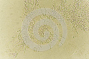 Pseudohyphae and budding yeast cells in patient urine