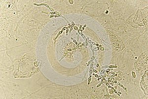 Pseudohyphae and budding yeast cells in patient urine