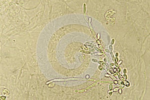 Pseudohyphae and budding yeast cells in patient urine photo