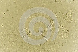 Pseudohyphae and budding yeast cells in patient urine photo