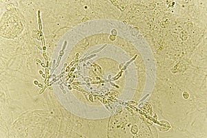 Pseudohyphae and budding yeast cells in urine photo