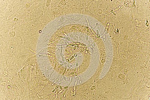 Pseudohyphae and budding yeast cells in patient urine