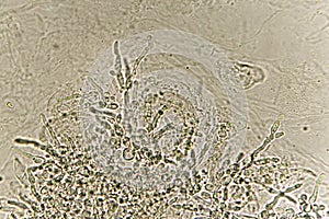Pseudohyphae and budding yeast cells in urine