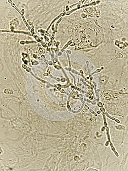 Pseudohyphae and budding yeast cells in urine