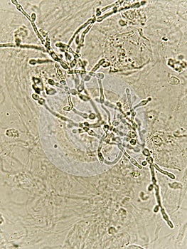 Pseudohyphae and budding yeast cells in urine photo