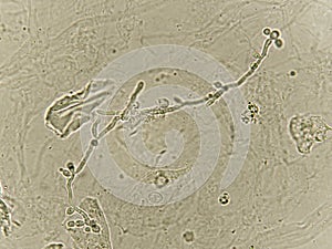 Pseudohyphae and budding yeast cells in urine