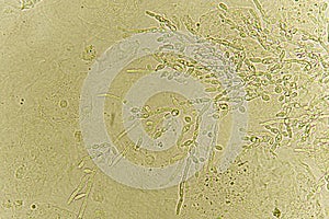 Pseudohyphae and budding yeast cells in urine
