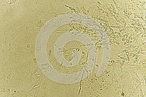 Pseudohyphae and budding yeast cells in urine photo