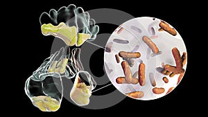Pseudomonas aeruginosa bacteria as a cause of sinusitis