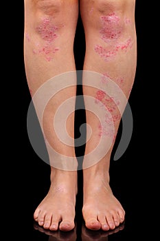 Psoriasis